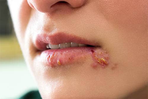 Lippenherpes - Symptome und Krankheitsverlauf