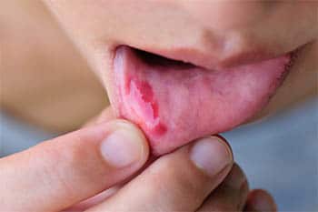 Entzündung der Mundschleimhaut - Bakterien